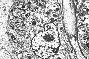 M, 38y. | granular cell tumor